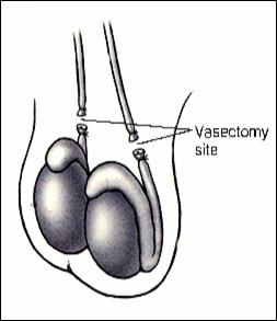 Vasectomy Reversal Diagram